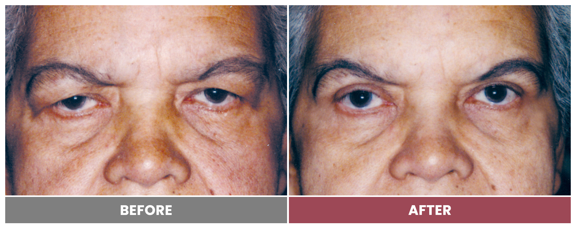 Upper Blepharoplasty - Case 31